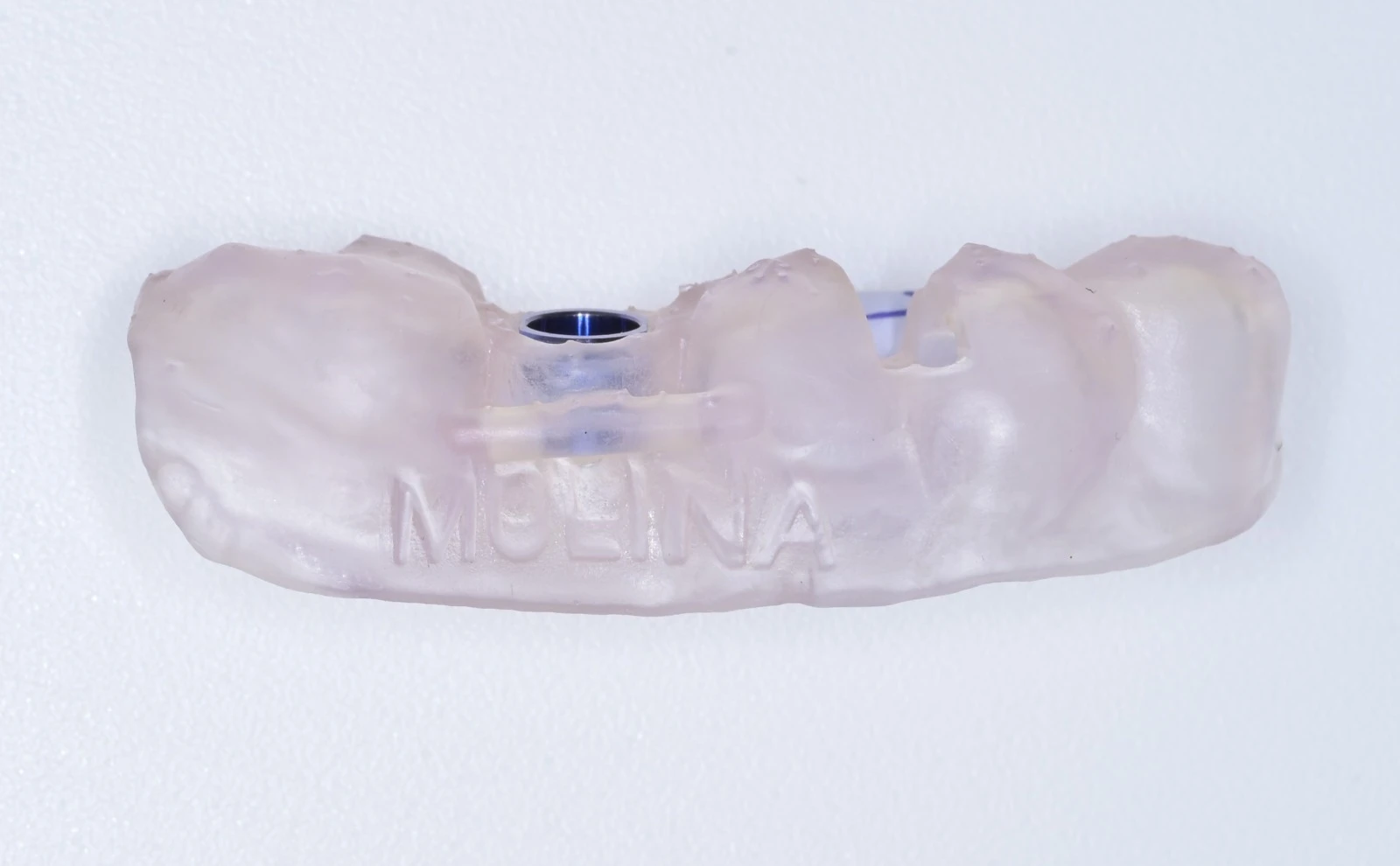 Guía quirúrgica de precisión para colocación de implantes dentales